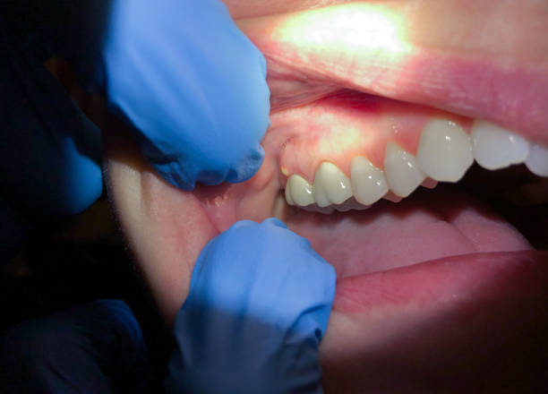Best Emergency Treatment for Dental Infections or Abscesses in Macdonnell Heights, NY